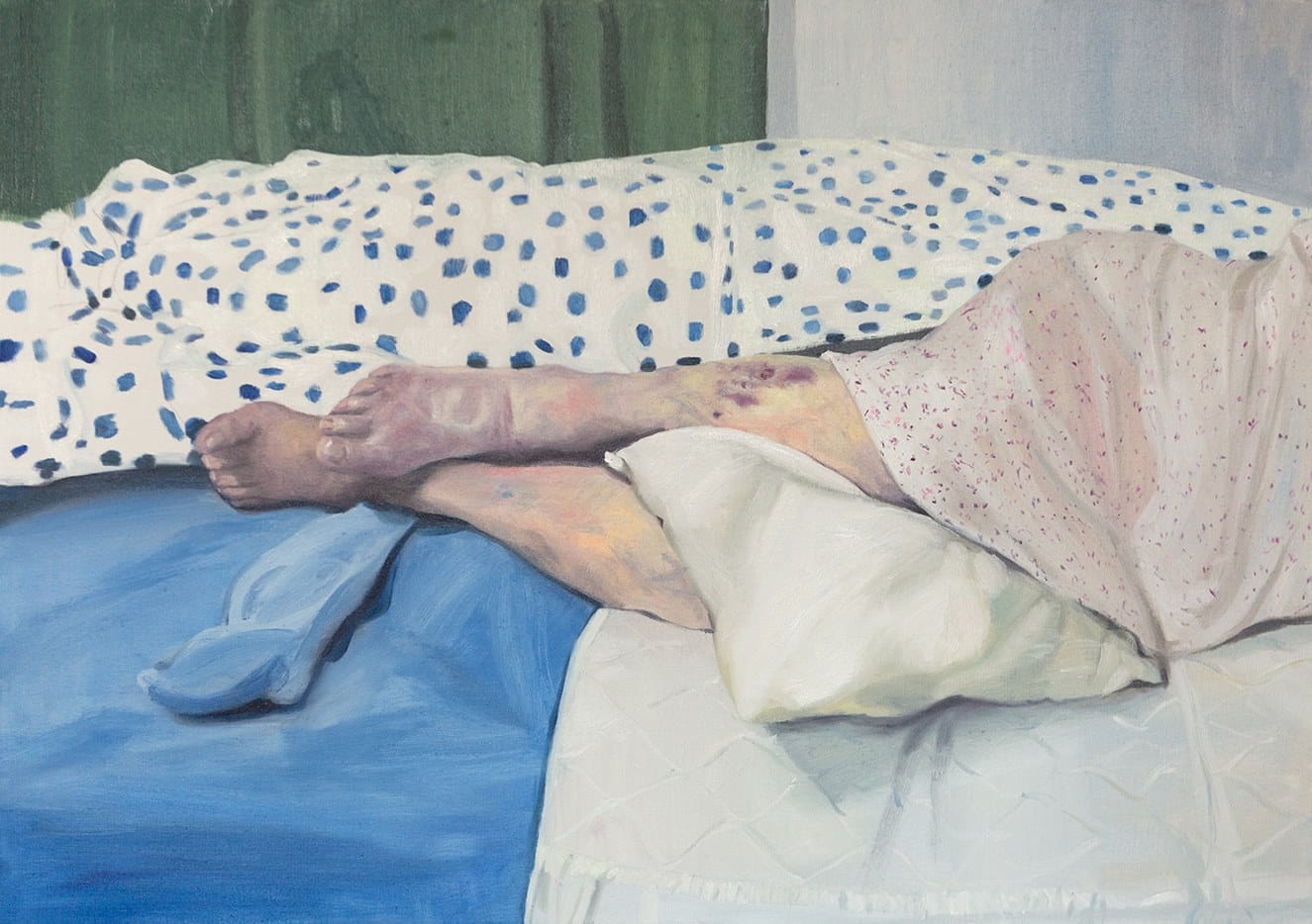 Jambes de personne âgée allongée sur un lit, jambes marquées de bleus